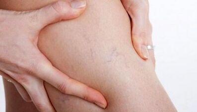 Πώς εκδηλώνονται οι κιρσοί των φλεβών στα πόδια