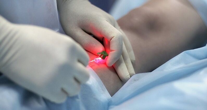 Χειρουργική αντιμετώπιση κιρσών